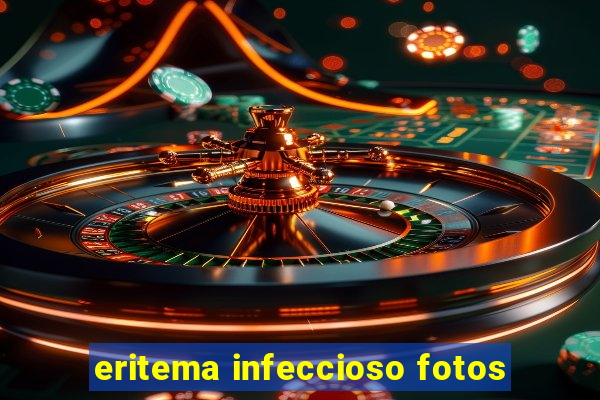 eritema infeccioso fotos